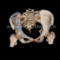 نمونه های جراحی شکستگی های دوستونی استابولوم. بررسی تخصصی 138 شکستگی دو ستونی استابولوم لگن