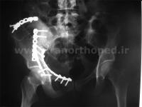 نمونه های جراحی شکستگی های دوستونی استابولوم. بررسی تخصصی 125 شکستگی دو ستونی استابولوم لگن