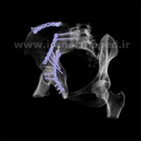 نمونه های جراحی شکستگی های دوستونی استابولوم. بررسی تخصصی 141 شکستگی دو ستونی استابولوم لگن