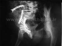 نمونه های جراحی شکستگی های دوستونی استابولوم. بررسی تخصصی 127 شکستگی دو ستونی استابولوم لگن
