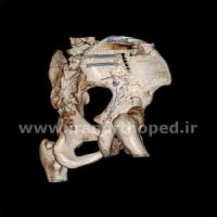 نمونه های جراحی شکستگی های دوستونی استابولوم. بررسی تخصصی 140 شکستگی دو ستونی استابولوم لگن