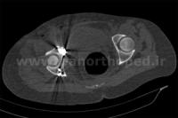نمونه های جراحی شکستگی های دوستونی استابولوم. بررسی تخصصی 134 شکستگی دو ستونی استابولوم لگن