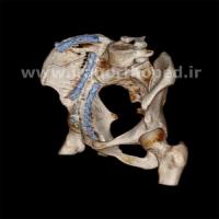 نمونه های جراحی شکستگی های دوستونی استابولوم. بررسی تخصصی 137 شکستگی دو ستونی استابولوم لگن