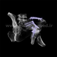 نمونه های جراحی شکستگی های دوستونی استابولوم. بررسی تخصصی 143 شکستگی دو ستونی استابولوم لگن