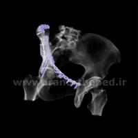 نمونه های جراحی شکستگی های دوستونی استابولوم. بررسی تخصصی 142 شکستگی دو ستونی استابولوم لگن