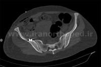 نمونه های جراحی شکستگی های دوستونی استابولوم. بررسی تخصصی 130 شکستگی دو ستونی استابولوم لگن