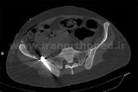 نمونه های جراحی شکستگی های دوستونی استابولوم. بررسی تخصصی 128 شکستگی دو ستونی استابولوم لگن
