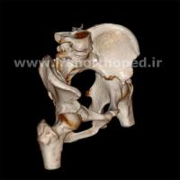 شکستگی عرضی استابولوم لگن