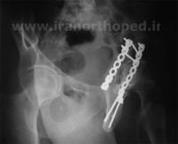 شکستگی لبه پشتی استابولوم لگن