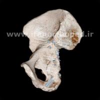 شکستگی ستون و لب پشتی استابولوم لگن