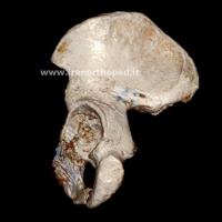 شکستگی تی استابولوم لگن