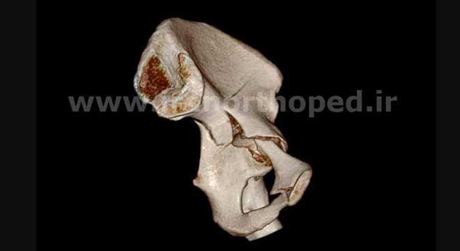 نمونه های جراحی شکستگی های دوستونی استابولوم. بررسی تخصصی 1 شکستگی ستون قدامی استابولوم لگن