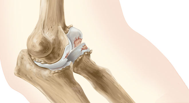 ساییدگی و آرتروز آرنج