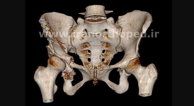 استئوتومی گنز دیسپلازی استابولوم