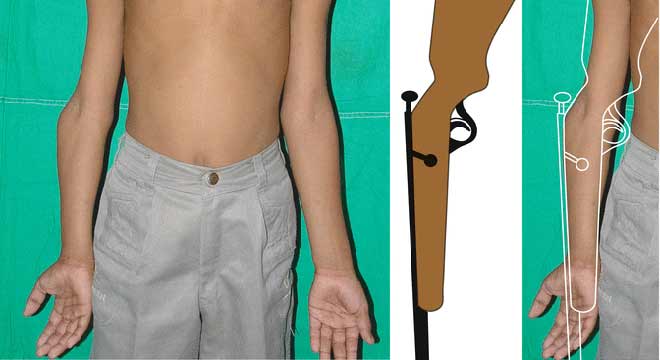 تغییر شکل مفصل آرنج. کوبیتوس والگوس و واروس 1 تغییر شکل ارنج