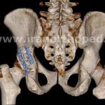 شکستگی عرضی استابولوم لگن