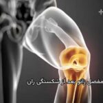 خشکس زانو بعد از شکستگی های استخوان ران را چگونه پیشگیری و درمان کنیم