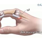 انگشت ماشه ای یا تریگر فینگر
