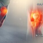 آرتروز زانو چه علائمی دارد و درمان آن چیست
