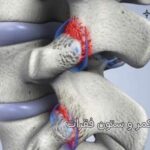 آرتروز کمر و ستون فقرات
