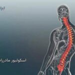 اسکولیوز مادرزادی