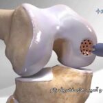 ضایعات و اسیب های غضروف زانو