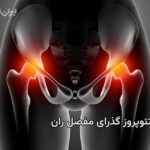 پوکی استخوان گذرای مفصل ران چیست