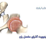 سینوویت گذرای مفصل ران