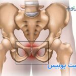 استئیت پوبیس چیست