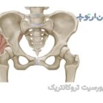 بورسیت تروکانتریک چیست و چگونه درمان میشود