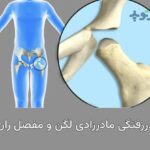 دررفتگی لگن مادرزادی