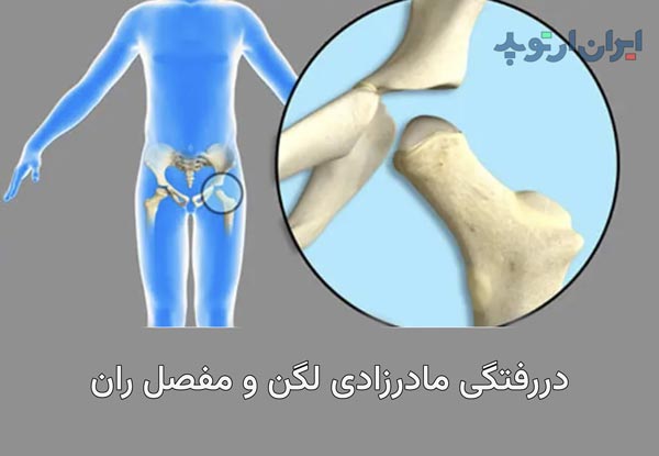 دررفتگی لگن مادرزادی
