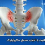 التهاب مفصل ساکروایلیاک از علل مهم درد پشت باسن است