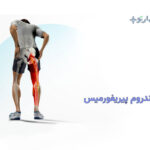 سندروم پیریفورمیس چیست