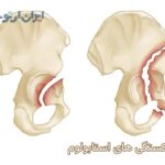 شکستگی استابولوم