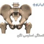 شکستگی استرسی لگن چیست