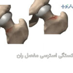 شکستگی استرسی مفصل ران چیست