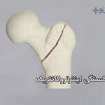 شکستگی اینترتروکانتریک چیست و چگونه درمان میشود