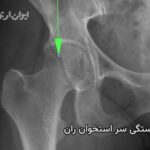 شکستگی سر استخوان ران یا پیپکینز چیست