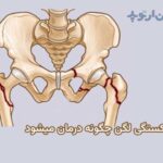 شکستگی لگن چیست و چگونه درمان میشود