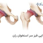 لغزش اپی فیز سر استخوان ران یا بیماری اسلیپ چیست