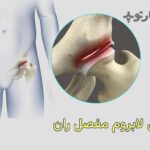 درمان پارگی لابروم مفصل ران چیست