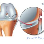 پارگی رباط جانبی زانو چگونه درمان میشود