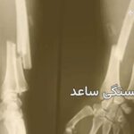 شکستگی ساعد