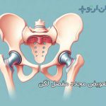 جراحی مجدد و تعویض دوباره مفصل ران