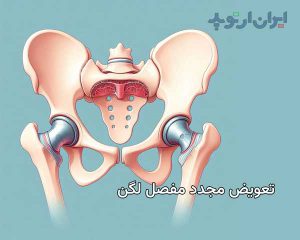 جراحی مجدد و تعویض دوباره مفصل ران