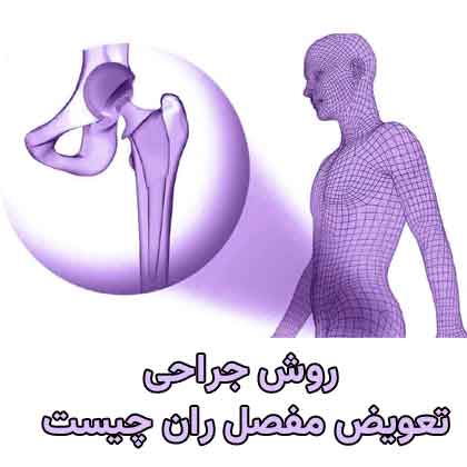 تکنیک جراحی تعویض مفصل ران